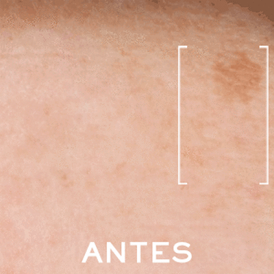 Imagen de piel con manchas, mostrando el estado 'Antes' de un tratamiento dermatologico.